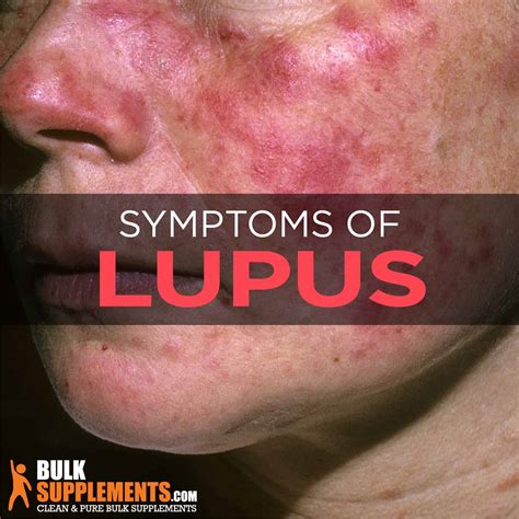 Lupus .